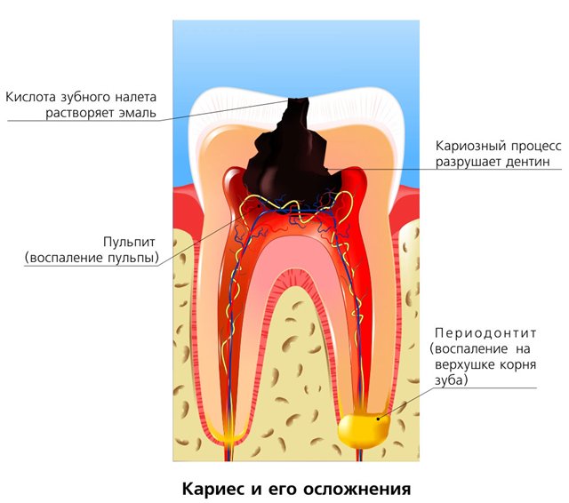 Схема периодонтита зуба