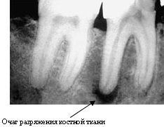 Рентгенограмма периодонтита зуба