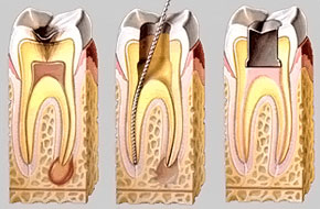 Схема лечения пульпита зуба